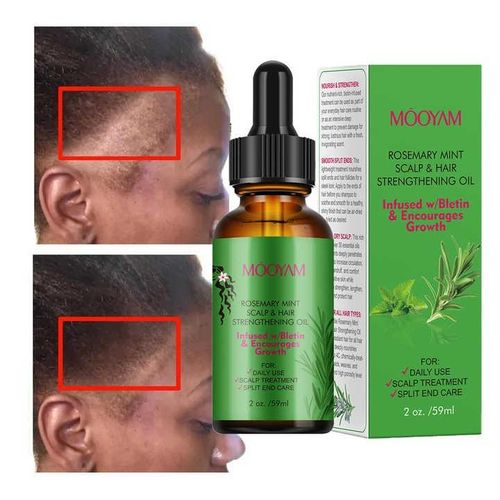Rosemary Mint Scalp & Hair Strengthening Oil 100% Pure Organic Oil Scalp Treatment With Biotin Rosemary Mint Oil Nourishing Treatment