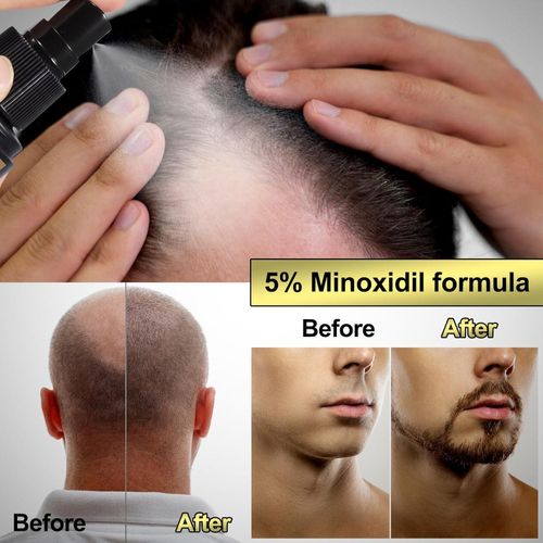 Care Plus 5% Minoxidil for Men and Women Hair Growth Serum-Hair Regrowth Topical Spray Infused With Biotin-Thinning Hair and Anti Hair Loss Treatment for Thicker Longer Fuller Healthier Hair.