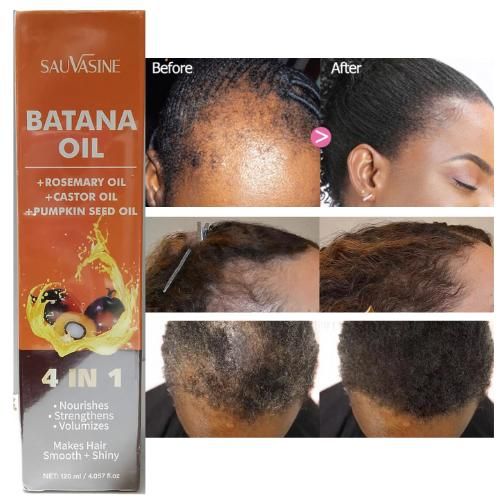 Sauvasine Batana Oil 4 In 1 Intense Hair Growth, Repair & Shine Formula With Rosemary, Castor & Pumpkin Seed Oils β 120ml