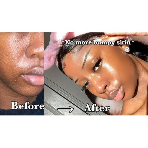 Revitale Face and body Perfecting Soap for Texture and Body Acne- Advanced Salicylic Acid Scrub Soap