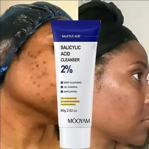 MOOYAM Facial Cleanser Acne Remover Face Wash With Salicylic Acid Oil Control Acne Removal Dark Spots Remover Face Wash