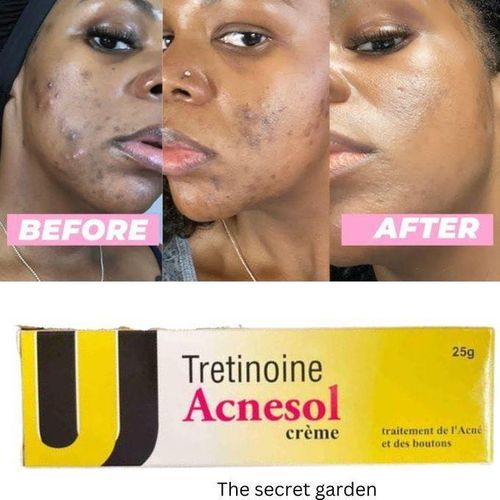 Acnesol Tretinoin Acne Cream 25g Powerful Acne Treatment For Clearer Smoother Skin